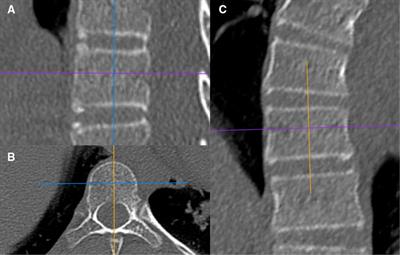 Hounsfield unit for assessing asymmetrical loss of vertebral bone mineral density and its correlation with curve severity in adolescent idiopathic scoliosis